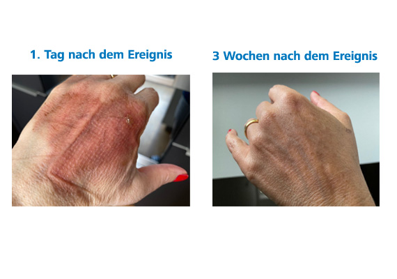 Verbrennungsbehandlung mit BurnFree Verbrennungsbehandlung mit BurnFree